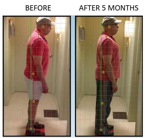 j_simmons_posture_before__amp__after - Complete Spine Solutions