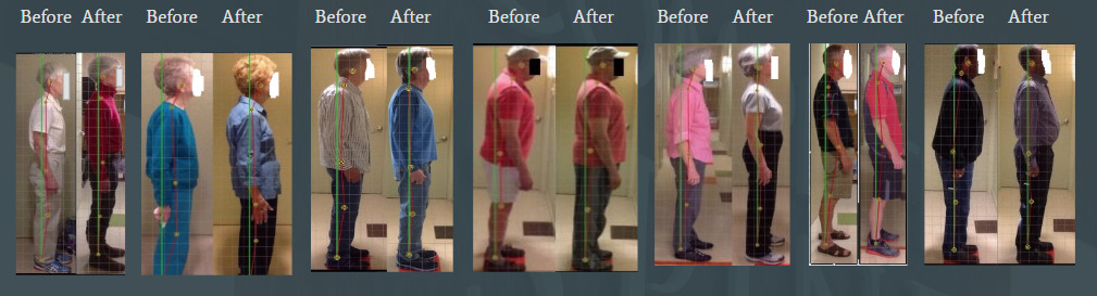 before and after posture correction